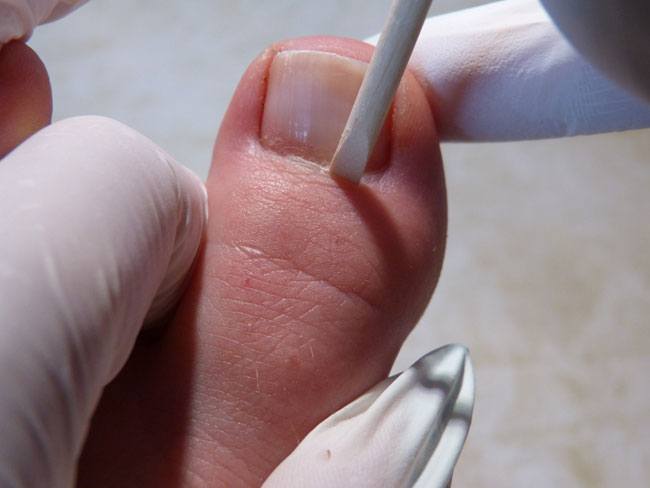 Fußnägel lackieren Nagelhaut zurück schieben